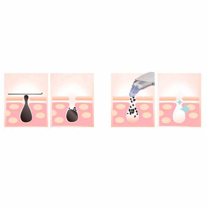 Mini Automatic Blackhead Acne Pore Suction Remover & Skin Cleanser with 3 Suction Modes and 5 Multif