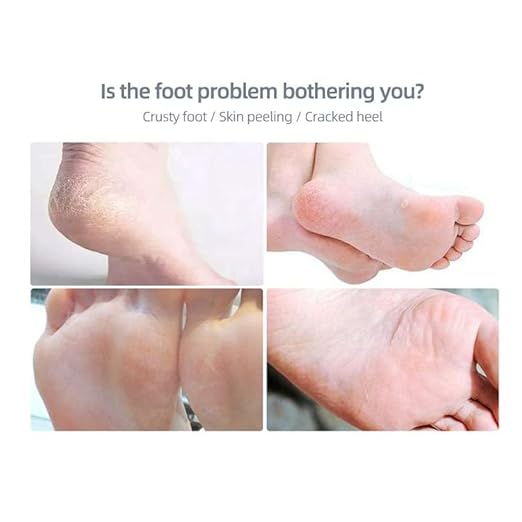 Electric Foot Callus Remover with 360° Rotating Roller, USB Rechargeable & Battery Operated with Washable Head for Cracked Heels, Hard Skin & Corn Removal